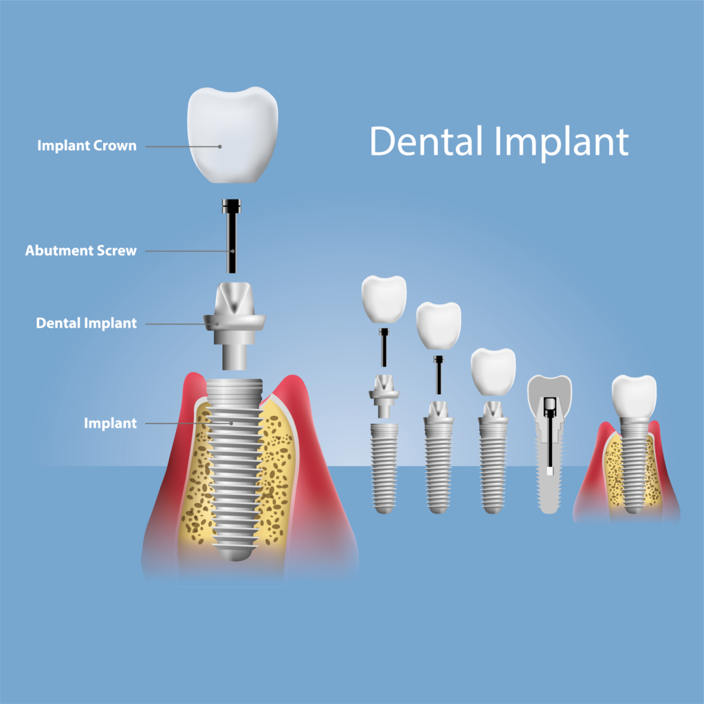 Dental Implants Procedure Advantages Risks And More Distinguished Smiles