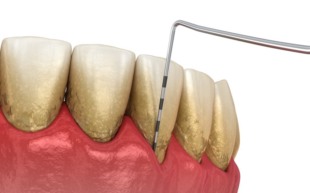 Periodontal disease (Gum Disease): Symptoms, Causes & Treatment